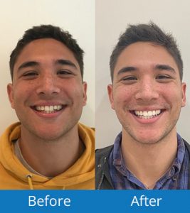 Invisalign